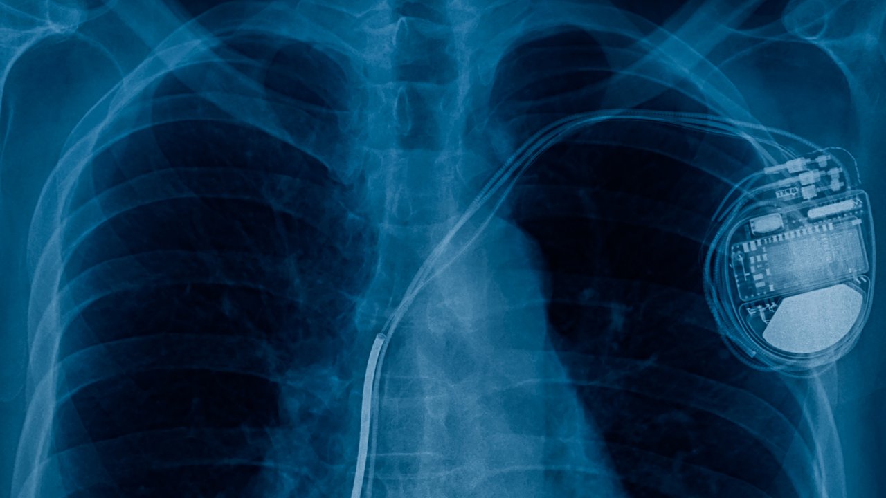 x-ray of pacemaker made with medical-grade titanium